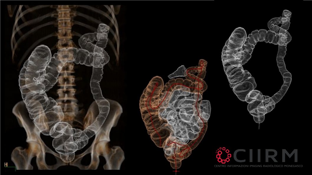 Colonscopia Virtuale 1 Colonscopia Virtuale 1