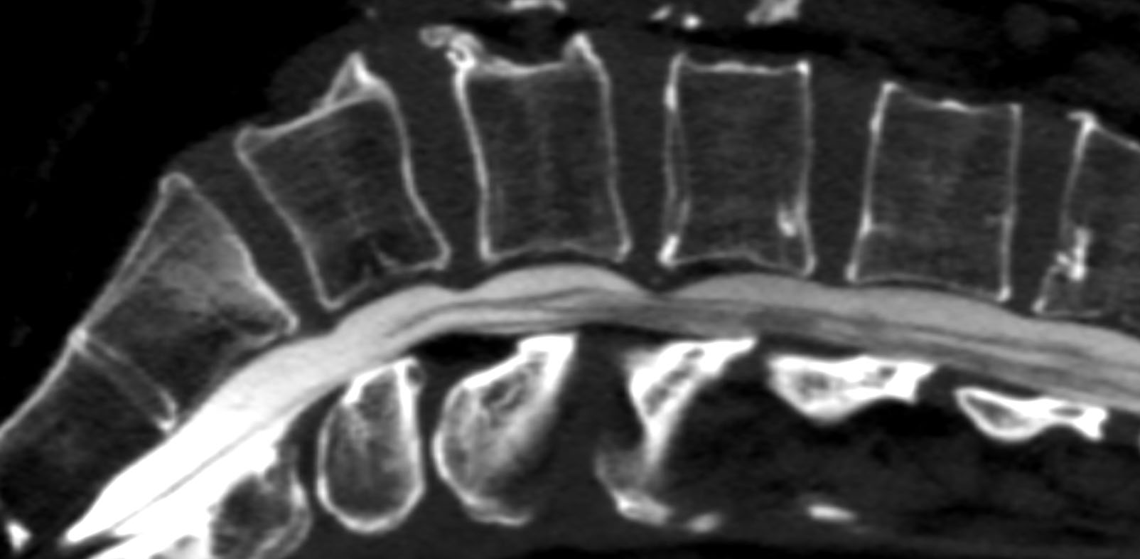 Mielografia TC Mielografia TC